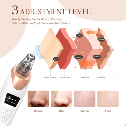 2024 Newest Blackhead Remover Pore Vacuum,Facial Pore Cleaner-5 Suction Power,5 Probes,USB Rechargeable Blackhead Vacuum Kit Electric Acne Extractor Tool for Adult